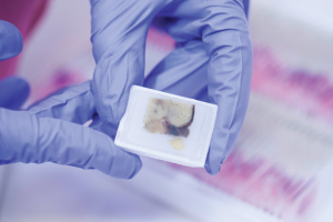 The use of tissue biopsies for cancer diagnosis is widespread, yet the practice is burdensome, expensive, and carries risks of infection or other health complications. Photo courtesy Qiagen and Andreas Fechner. 