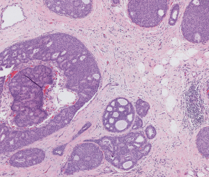 Ductal carcinoma in situ of the breast, hematoxylin and eosin stain. Photo courtesy Roche Diagnostics. 